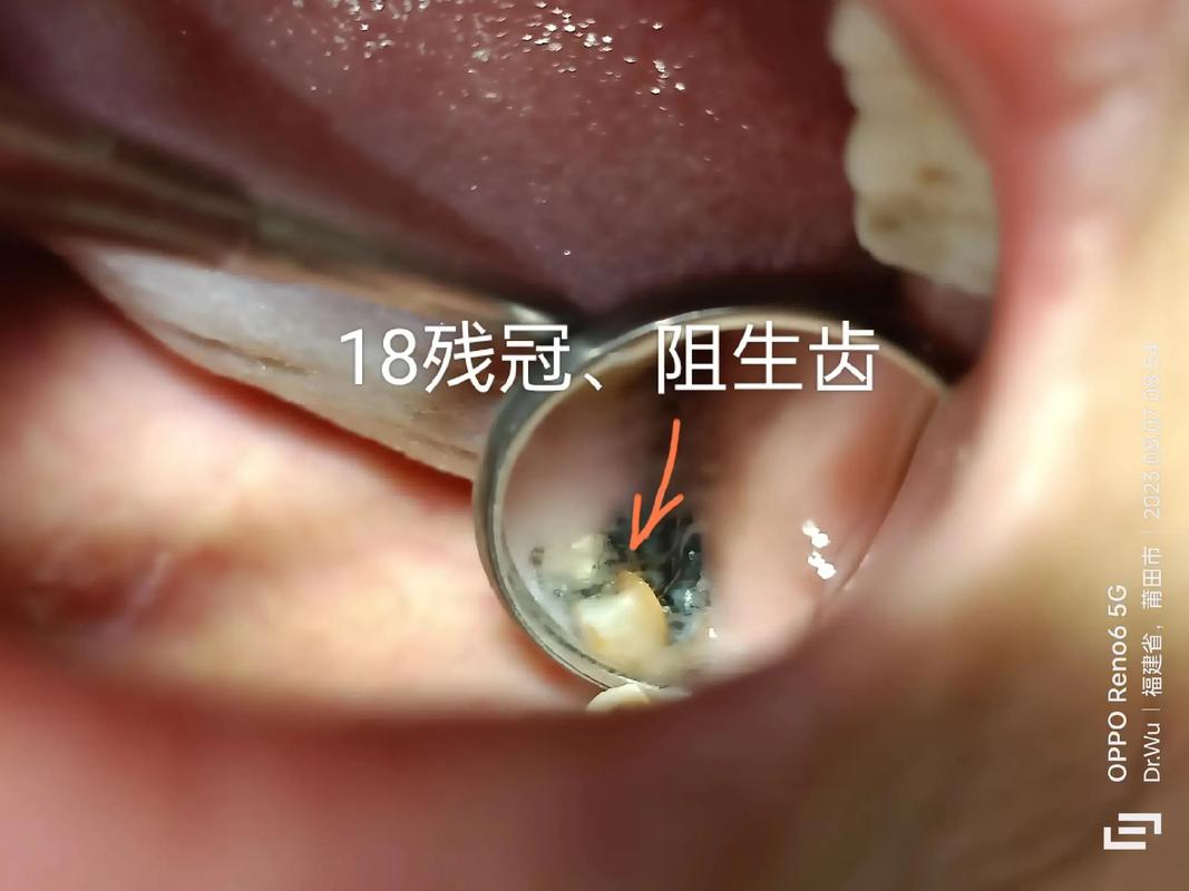 拔智齿后坐飞机爆血,拔智齿后坐飞机爆血怎么办